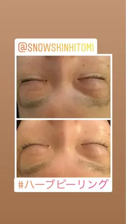 目の疲れ&3種類の目元ケア青クマ/茶クマ/黒クマ/シワ/目袋洗顔→目元マッサージ→目元かっさ→目元マシーン→パック