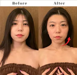 【U22限定】小顔矯正コルギ＋美肌ケア〈毛穴洗浄orパック〉