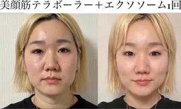 SNSで話題！テラボーラー！速攻小顔！むくみ&たるみにも！即日メイクOK！大満足コース♪平日昼間限定！