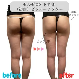 【ずっと同価格】下半身90分♪ヒップUP/美脚/むくみ　キャビテーション＋ラジオ派＋吸引🔥￥6000※生理中NG