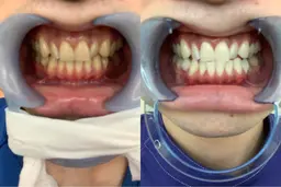 🉐歯科提携サロン🦷💎【歯科レベルの効果】ハイパー照射機使用❣️高性能ホワイトニング8分×4回照射🌈