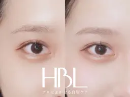 ＨＢＬ(ハリウッドブロウリフト)
