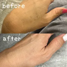 【ハンド】光ハンドケア 光フェイシャルでシミ・しわ・くすみ同時に効果があり、お肌のお悩み解決！透明感のある印象に！！