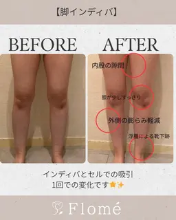 【女性限定】全身スッキリコース🎀よもぎ蒸し→腸もみ→痩身(二の腕・お腹・脚)→耳ツボジュエリー