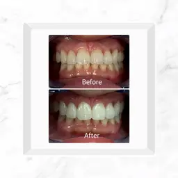 セルフホワイトニング　10分×2照射