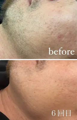 【メンズ顔脱毛】Men's脱毛👨🏻美肌パック付き✨ミニモ価格！髭脱毛お任せください！イオン導入付きで美肌効果🌿