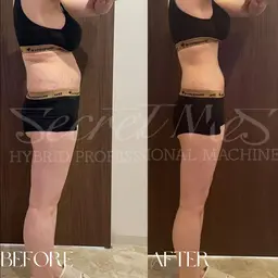 🎍新春記念🎍【セルフ痩身|1部位30分】最先端痩身マシン当て放題🔥ダイエット/冷えむくみ緩和 ¥1100→¥980