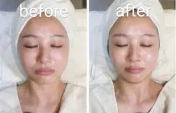 ハイドラフェイシャル+乳酸ピーリング（植物性由来のピーリングで肌の輝きと肌を正常なターンオーバーに促す！