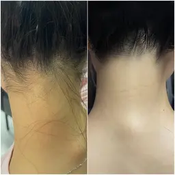 【イベント前の駆け込み歓迎！】うなじ美肌ケア✨シェービング付き◎