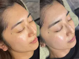 続けやすい肌育【フェイスワックス×ハーブピーリング】くすみ/毛穴退治☆ハリつや感アップ