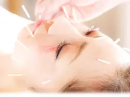 ✨✨美容鍼 ✨ ✨