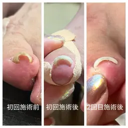 【巻き爪矯正(45分/1本​〜​)痛みの原因となる角質の除去、巻きの緩和をお手伝い。地味に痛い。そんな日々に終止符を！