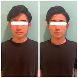 【小顔ケア】小顔EMS+ポレーション導入 ￥5,980‐