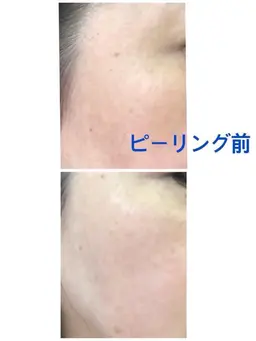 👆毛穴ケアはピーリングです。👆ピーリング＋フェイシャルトリートメント