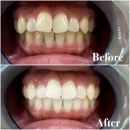 もっと激白ホワイトニング‼️圧倒的な白さ✨✨Wプレミアムホワイトニング✨✨《合計110分照射3来店コース》✨🦷✨