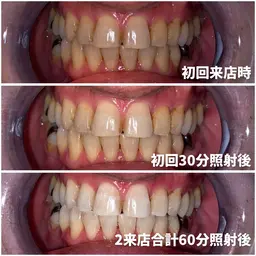 【成人式プラン】2来店合計60分照射コース