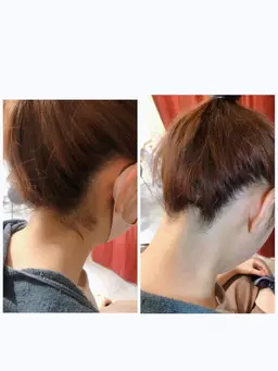 【痛くない】うなじ脱毛