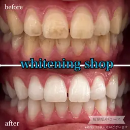 【都度払いケア】2回目以降の方 40分照射 ¥6,980