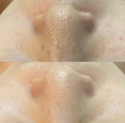 【毛穴・黒ずみケアに◎】REVIハーブピーリング