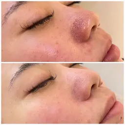 お悩み「毛穴」撃退コース