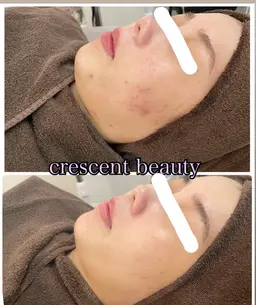 写真モニター価格💎ニキビ、肌荒れを繰り返さない肌に🫧国産高級ハーブピーリング🌿￥22000→¥7700