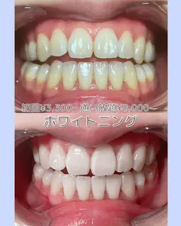 ✨🦷ホワイトニング初回🦷✨⏰60分