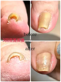 ミニモ限定モニター価格で半額‼️１本¥2,200！施術直後に開放感の巻き爪ケア👀痛みにサロナラ😭✨