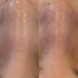 【4月先着10名様まで※残り5名様】どこでも1箇所お試しエクストラクション¥5500