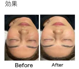 優しい剥離なしのハーブピーリング➕人幹細胞美容液をたっぷり入れこんでいきます。【現金のみ】