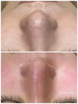 ✨人気No１✨フォト×顔脱毛【毛穴×ニキビ×乾燥×シミ×しわ×たるみ×くすみ×赤み×リフトUP】結果重視フォト脱毛✨