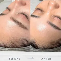 【牛田店限定】高速美肌脱毛⭐︎痛みもなく、スピード脱毛を実現！顔全体+Sランクヒト幹細胞培養液お仕上げ付き