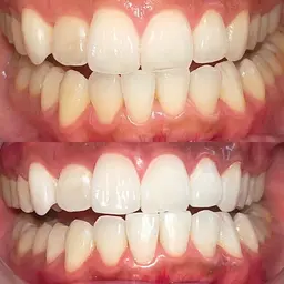 【当店人気No.1】見た目-5歳🎶その日にすぐ真っ白な歯へ🦷10分×4照射✨痛くない、しみない！歯の事は当店にお任せ