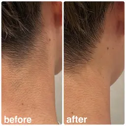 🌟襟足脱毛🌟一回で抜けた！減った！が実感できる脱毛