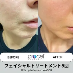 【本気の肌質改善】プロセルフェイシャル（凸凹肌）￥50,000→￥40,000