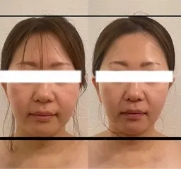 💖限定💖小顔コルギ、カッサ、ストーンセラピー💆♀️オリジナルコルギで理想に近づける!