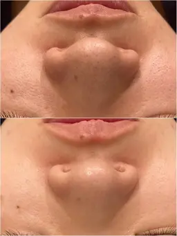 毛穴レスフェイシャルコース