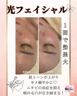 【新規】美肌光ケア