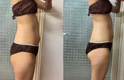 ｗキャビ、ｗ超音波、EMS特許取得マシーン【痩身/ダイエット1パーツ】ご希望の部位30分お得に体験！