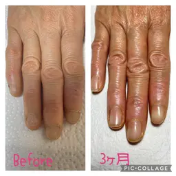 深爪集中ケアプログラム（ホームケア用品込み）