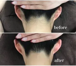 【意外と見られてる☆後ろ姿も美人に】うなじ脱毛2回セット