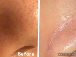 【毛穴黒ずみ角栓除去&ツルツル透明肌へ✨】ハイドロフェイシャル毛穴洗浄+フォト光フェイシャル ✨