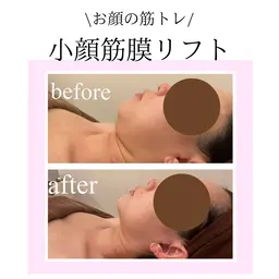 【👑ミニモ初回限定👑】水素毛穴洗浄➕小顔筋膜リフト！（６０分）