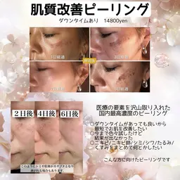 【国内最高濃度ピーリング】韓国美肌/ニキビケア