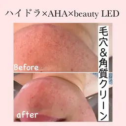 【普通肌・皮脂肌】角質ピーリング×ハイドラフェイシャル