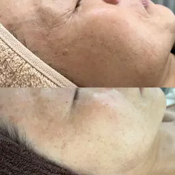 褒められ肌育成✨お悩みに合わせたオプション&ヘッドマッサージ付！周りと差をつけるならハーブピーリングにお任せ🌿