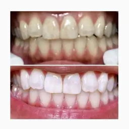 🦷新世代🪥歯のセルフホワイトニング