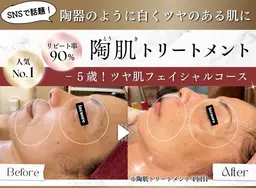 【人気No.1】ハーブピーリング 陶肌(とうき)トリートメント🌹ツヤ肌リフトアップコース 日進 長久手