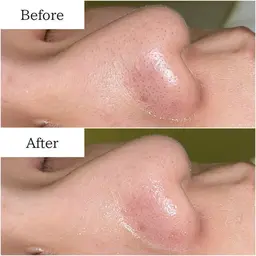 【平日限定】毛穴洗浄ハイドロスプラッシュ※男女OK！