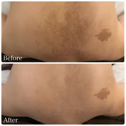 【背中上部or 下部/ハーブピーリング】今から夏に向けて美肌作り🫧今年こそかわいい服を着れる自分に👗毛孔性苔癬など