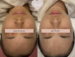 【毛穴・くすみリセット】透明感アップフェイシャル¥22000→